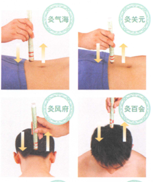 動脈粥樣硬化艾灸