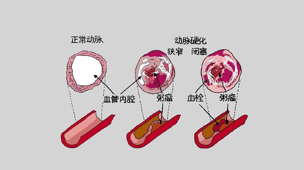 動脈硬化應(yīng)該注意哪些飲食戒律？