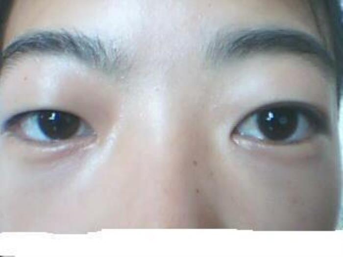 女人有點(diǎn)金魚眼面相是好的嗎？ 什么是金魚眼