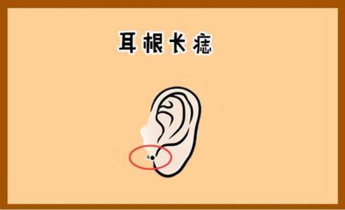 男人耳朵痣相會(huì)帶來好運(yùn)嗎 男人耳朵長(zhǎng)痣代表什么