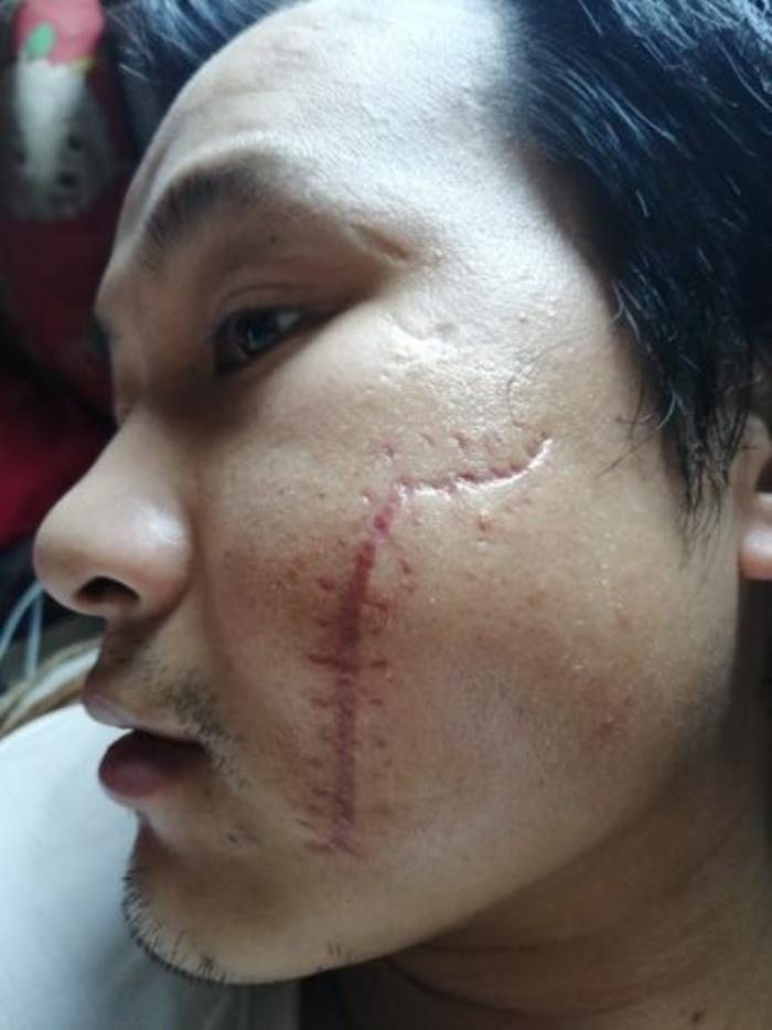 臉上有疤痕代表什么命運 臉上有疤的女人命好嗎