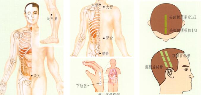 風(fēng)濕性關(guān)節(jié)炎刮痧