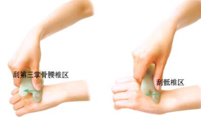 腰椎間盤(pán)突出刮痧
