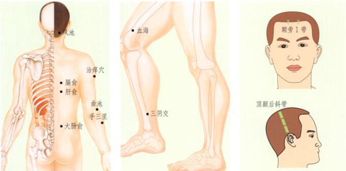 蕁麻疹刮痧